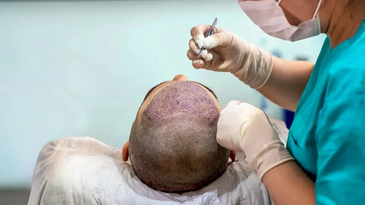 Advanced DHT no-shave hair transplant procedure using Choi Implanter Pen for natural results at Cosmo Radiance clinic in Hyderabad