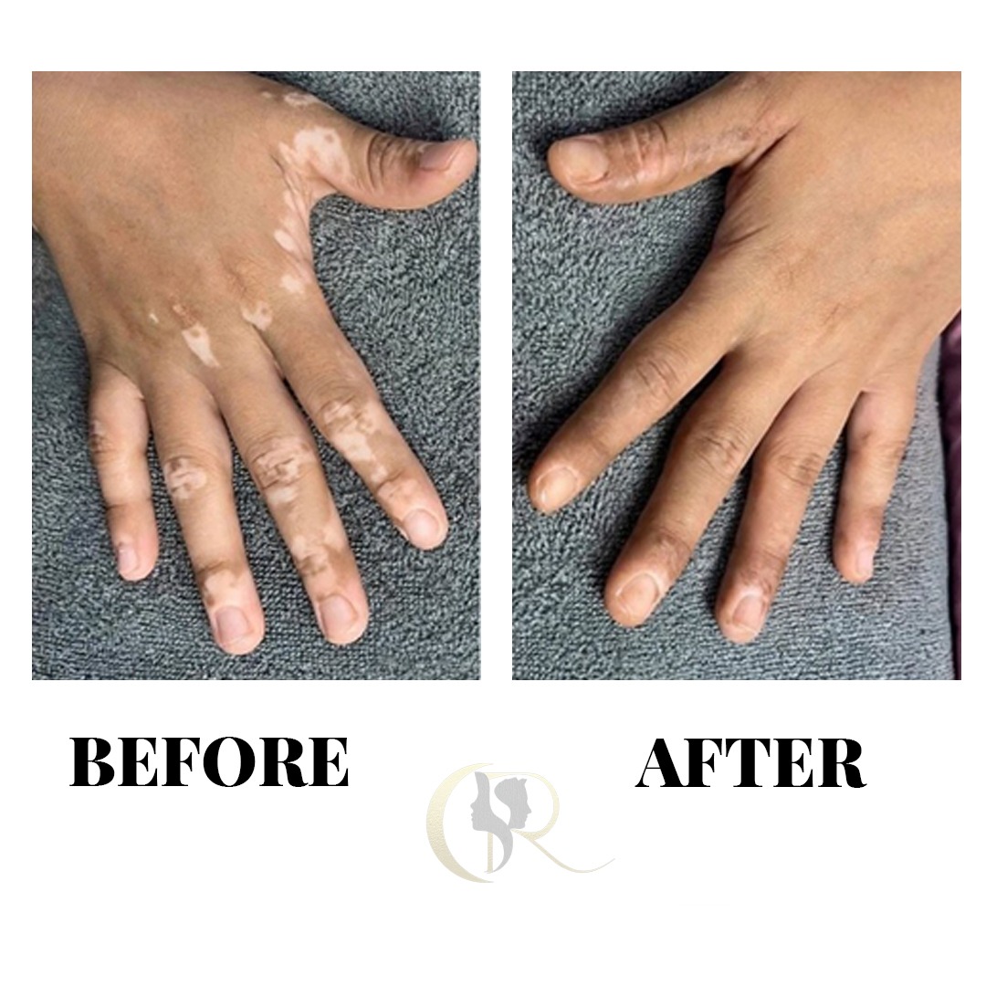 Multi-Digit Vitiligo Camouflage Before and After