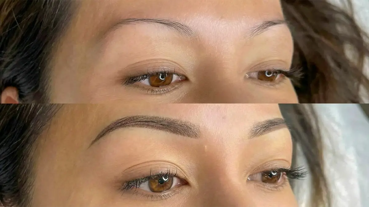 Precision Eyebrow Restoration & Transplant in Hyderabad