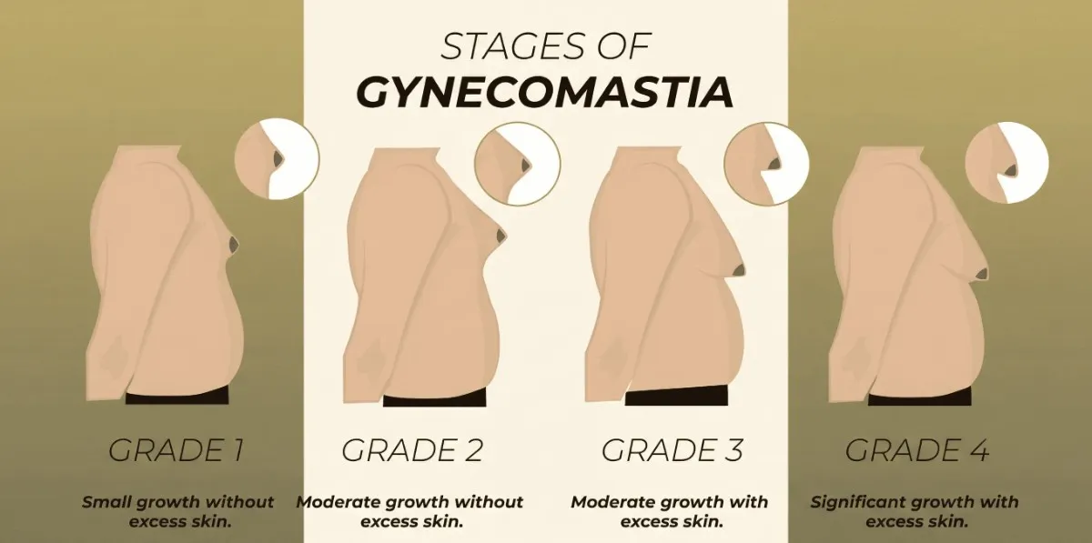 Comparison illustration showing Grades 1 to 4 of Gynecomastia severity