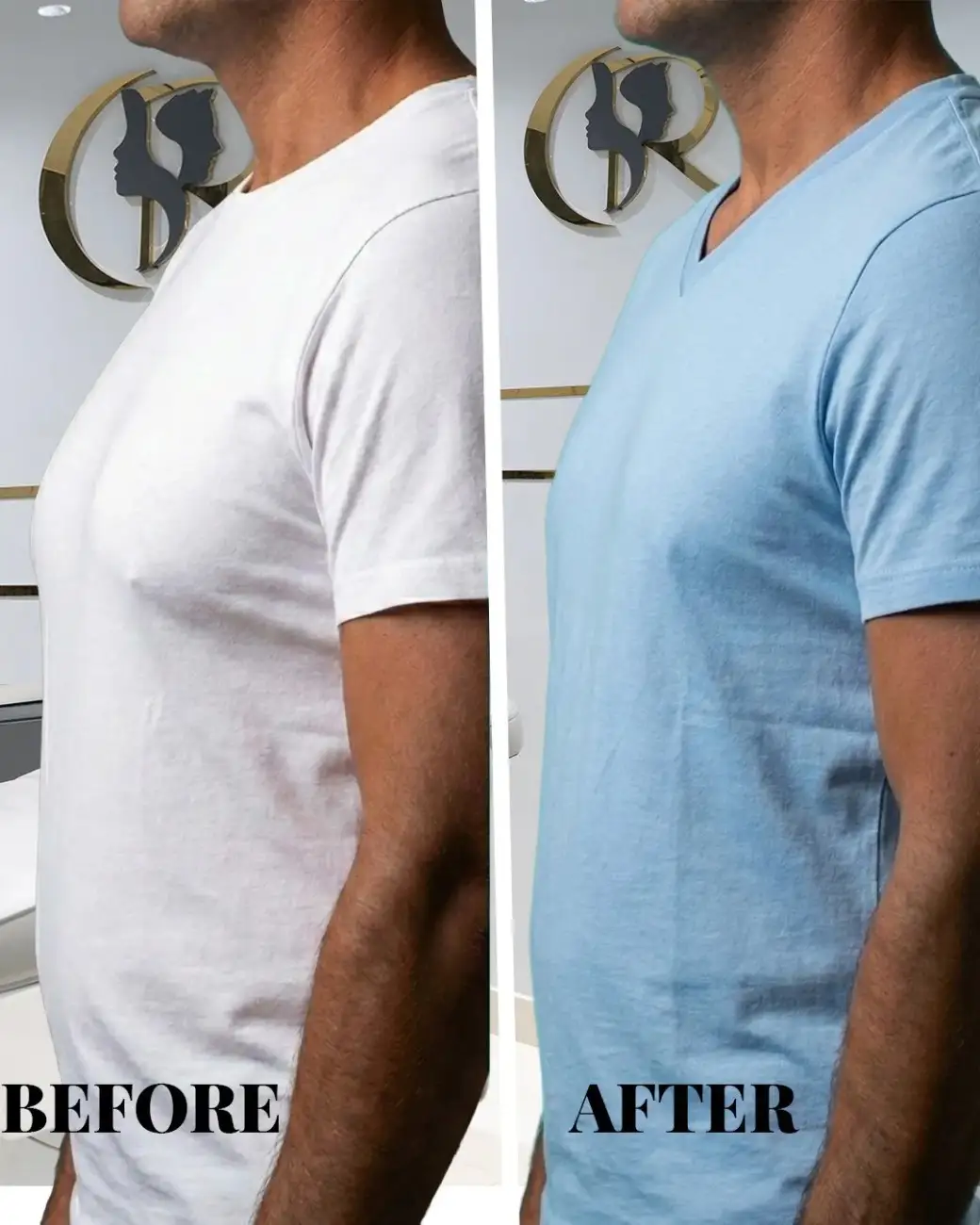 Cosmo Radiance result: Grade II Gynecomastia Correction