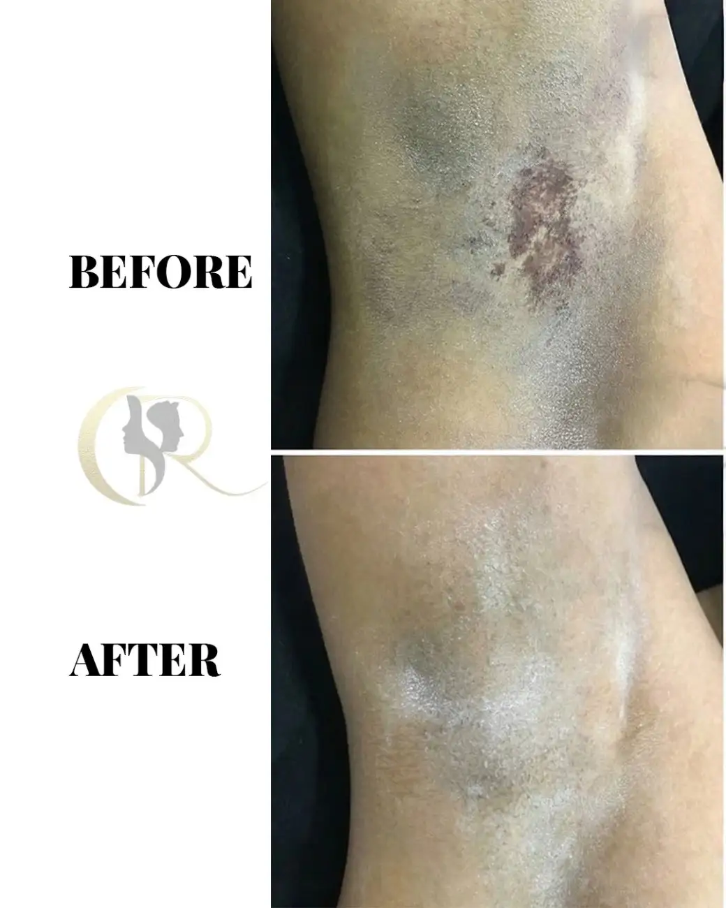 Treatment result
