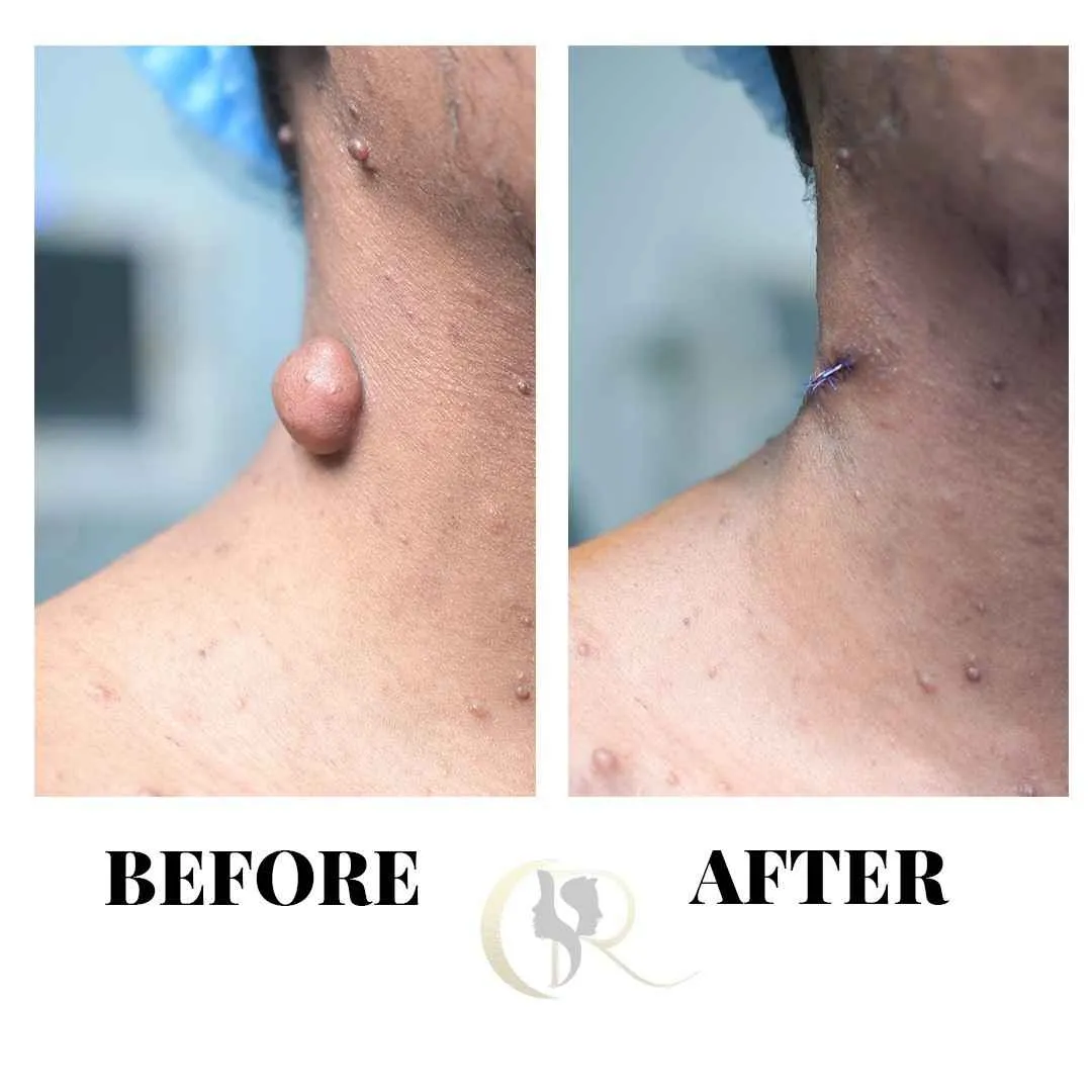 Best Neurofibromatosis Treatment in Hyderabad | Laser & Surgery