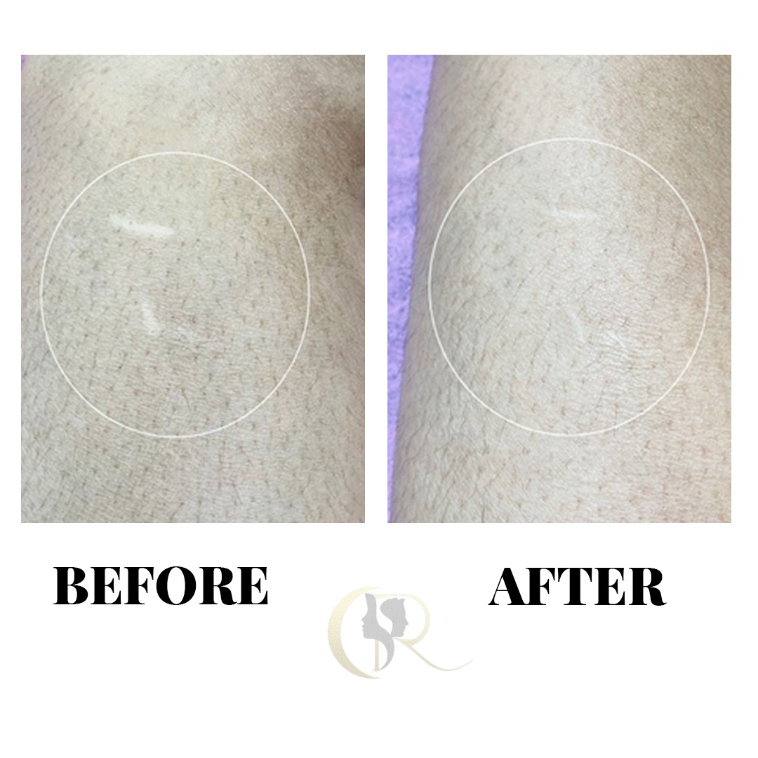 Linear Scar Leg Micropigmentation Before and After