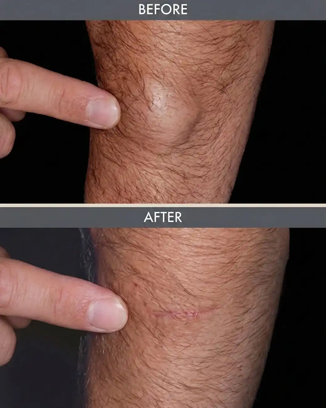 Cosmo Radiance result: VASER Lipoma Extraction