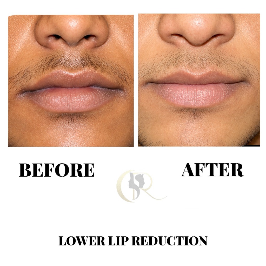 Before and After Lower Lip Reduction Surgery at Cosmo Radiance Hyderabad
