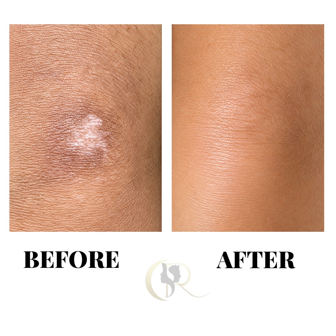 Knee Joint Hypopigmented Scar Camouflage Before and After