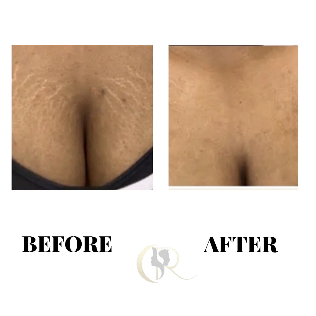 Chest Stretch Marks Striae Camouflage Before and After
