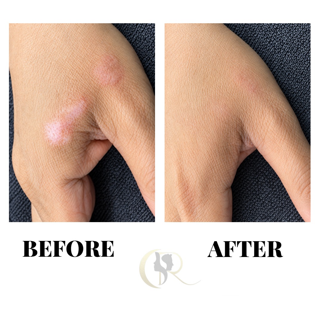 Surgical Scar Hand Burn Camouflage Before and After