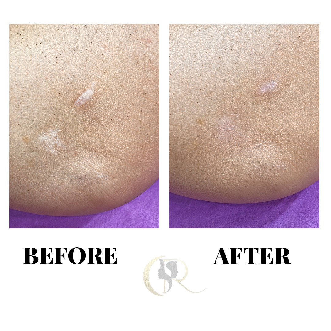 Traumatic Scar Skin Tone Matching Before and After