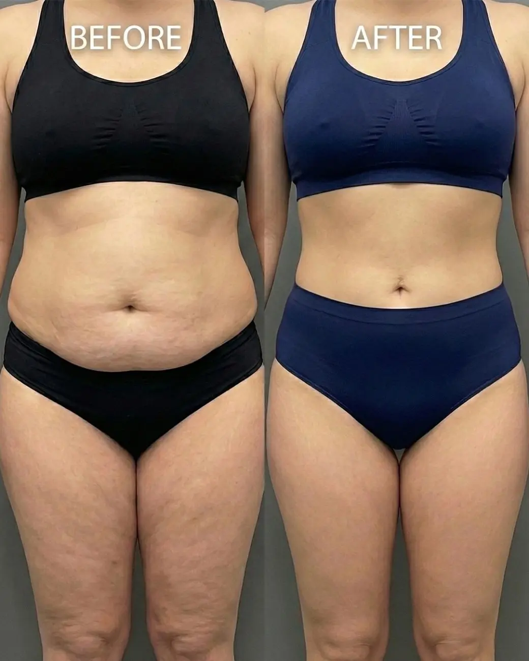 Advanced Tummy Tuck Surgery in Hyderabad | Abdominoplasty