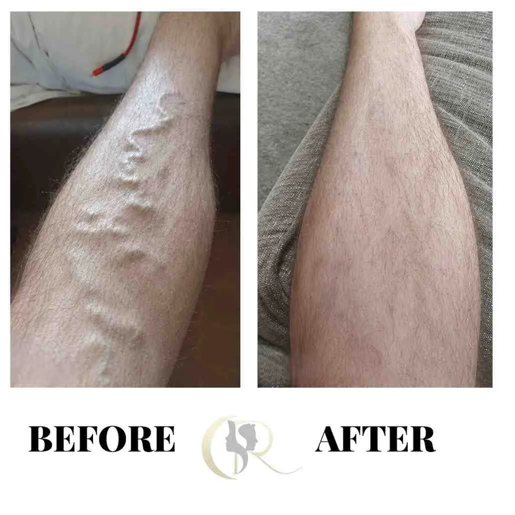 Best Varicose Veins Treatment in Hyderabad | 0% EMI