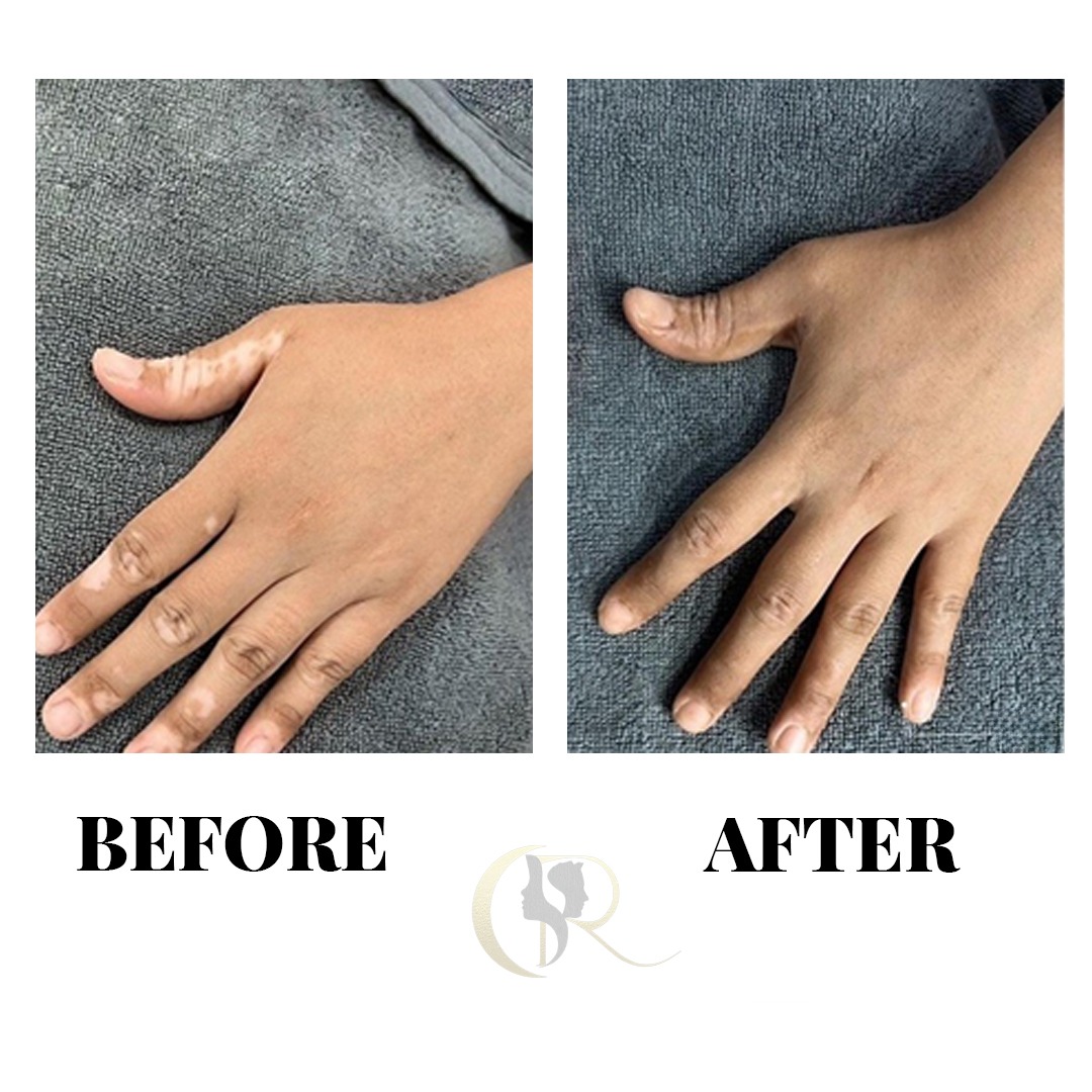 Vitiligo Finger and Thumb Skin Camouflage Before and After