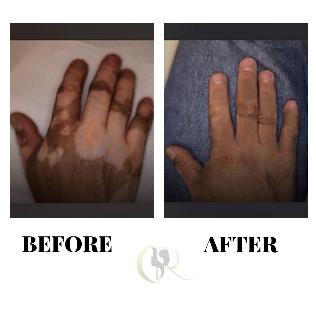 Vitiligo Hand Camouflage Medical Micropigmentation Before and After