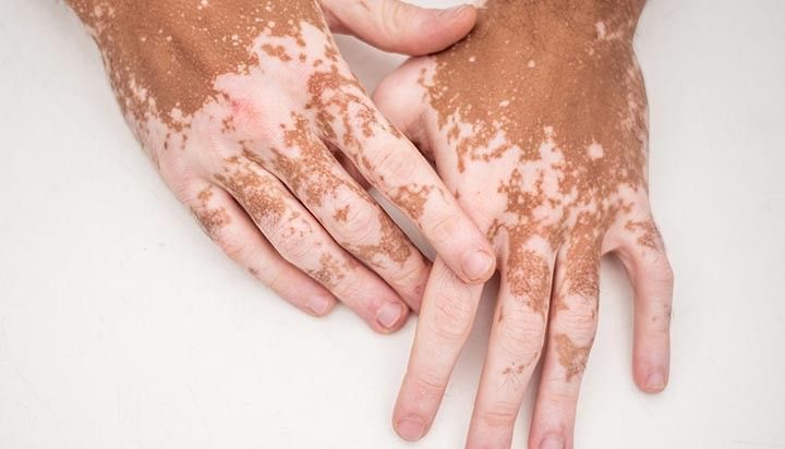 Advanced Autoimmune Skin & Vascular Disease Treatment in Hyderabad